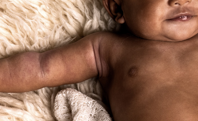 eczema black baby